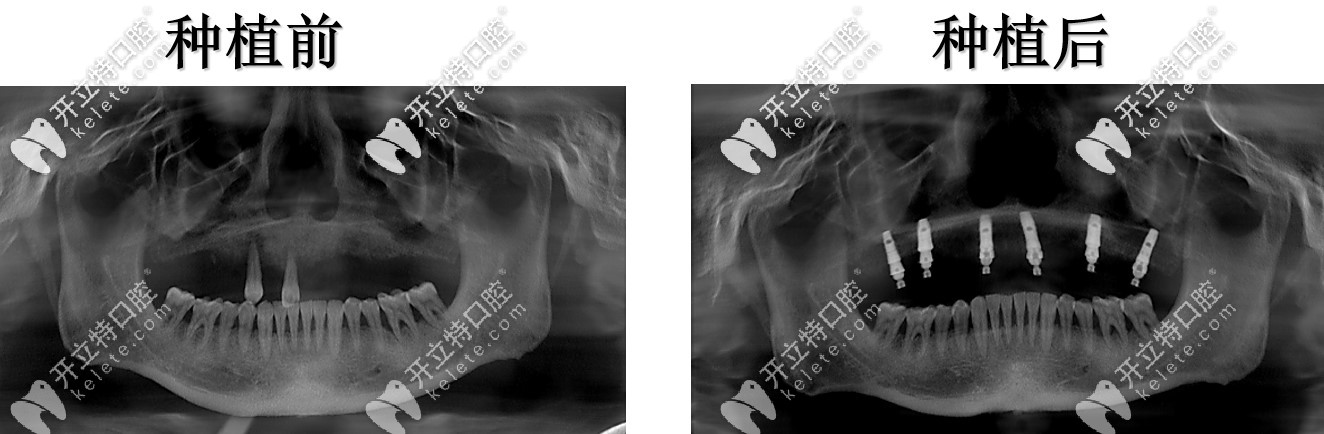 上半口六顆種植恢復(fù)