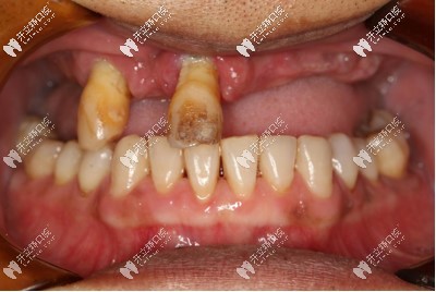 成都極光口腔45歲就做德國icx上半口種植牙,價(jià)格和恢復(fù)效果真的都不后悔