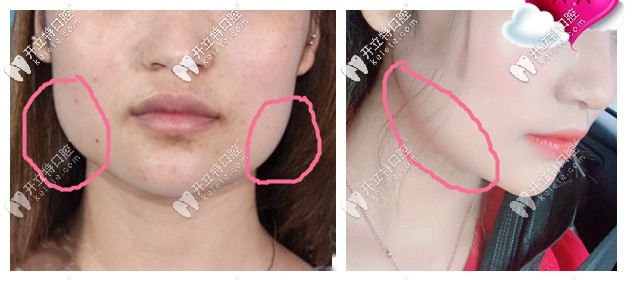 下頜骨肥大做正頜手術(shù)前后效果圖對比