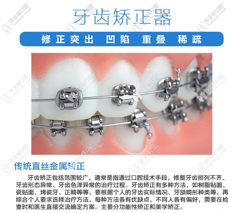 傳統(tǒng)直絲弓金屬矯正