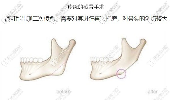 做之前要對目前主流的正頜手術(shù)方法進行了解