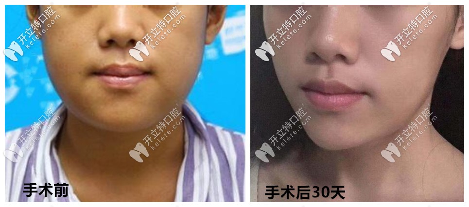 骨性地包天手術(shù)前后效果對比圖