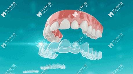 時(shí)代天使隱形牙套