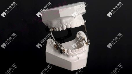 Herbst(赫氏矯治器）