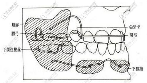 活動(dòng)矯正器結(jié)構(gòu)圖