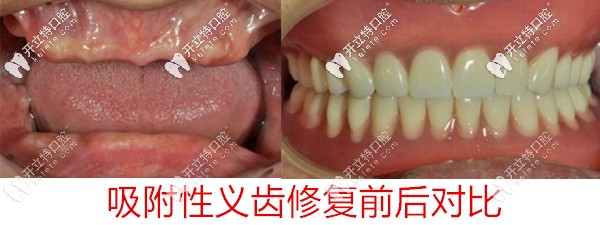 吸附性義齒前后對比