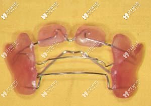 功能性矯正器的外觀