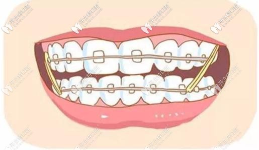 傳統(tǒng)的鋼絲矯正