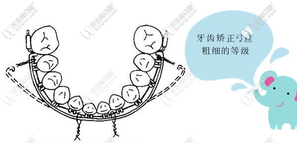 牙齒正畸的弓絲粗細等級