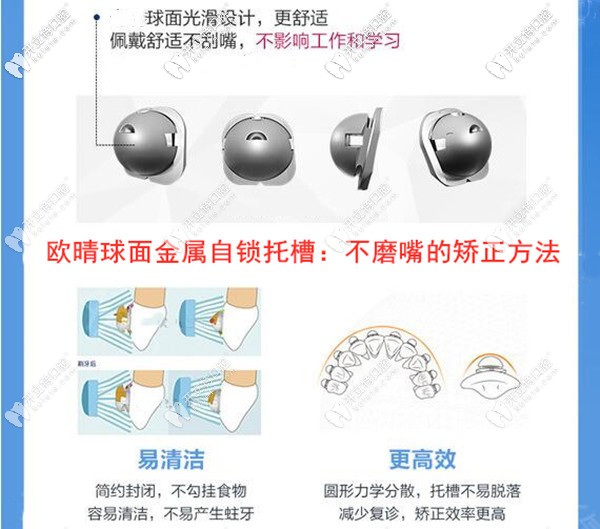 歐晴金屬自鎖托槽牙齒矯正的優(yōu)勢