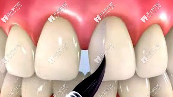 牙齒稀疏間隙大且牙弓大的人