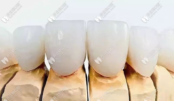 全瓷冠常見品牌及價格介紹