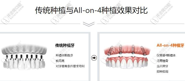 ALL-on-4即刻負重種植牙優(yōu)勢 ALL-on-4即刻負重種植牙優(yōu)勢