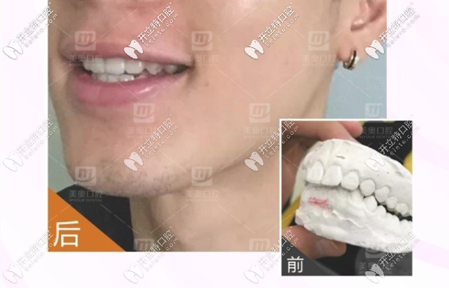 30歲前牙深覆合矯正前后對(duì)比圖