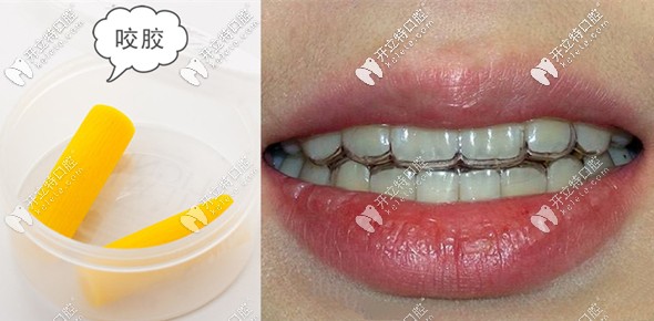 在<!--<i data=20240703-sp></i>-->戴透明牙套矯正牙齒的體驗(yàn)