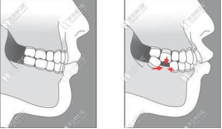 缺牙不及時種牙的危害
