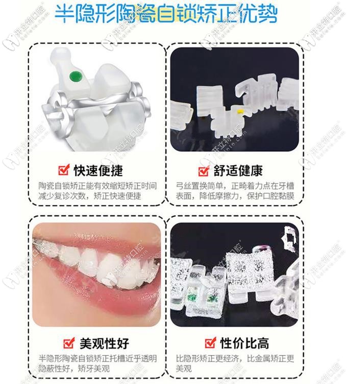 陶瓷自鎖矯正優(yōu)勢