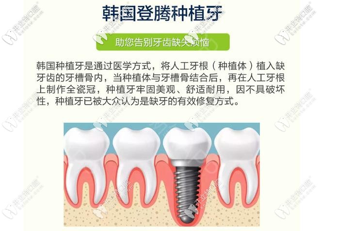 登騰種植體優(yōu)勢