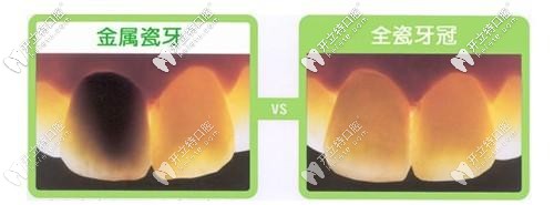 烤瓷牙和全瓷牙區(qū)別圖