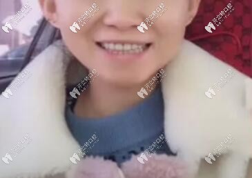 20歲滿口活動假牙照片