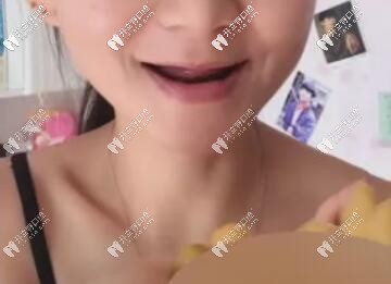 20歲全口無牙活像80歲老太