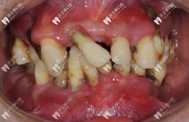 35歲重度牙周炎顧客的牙齒情況