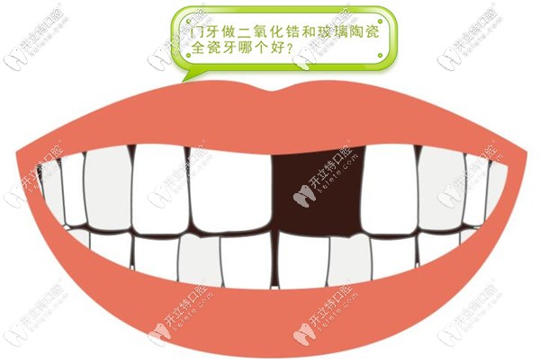 門牙做二氧化鋯和玻璃陶瓷全瓷牙哪個(gè)好