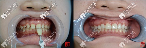 武漢小姐姐分享超薄美加瓷貼面修復(fù)門牙縫隙的效果及價格