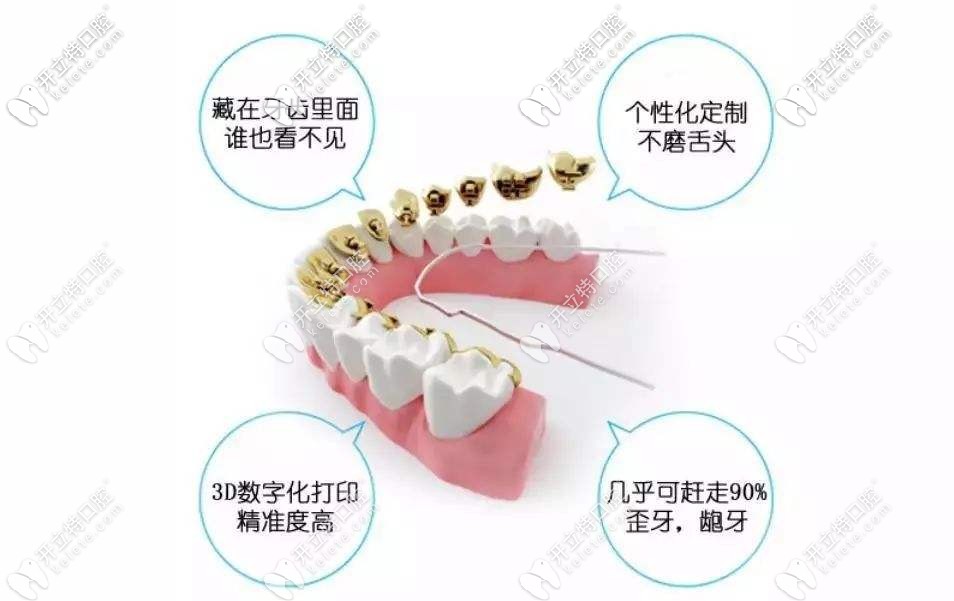 舌側(cè)隱形矯正優(yōu)勢圖