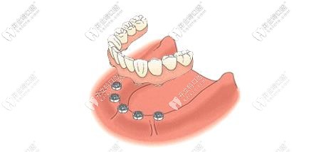 全口種植牙 全口種植牙