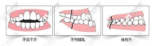 錯頜畸形的幾種癥狀 錯頜畸形的幾種癥狀