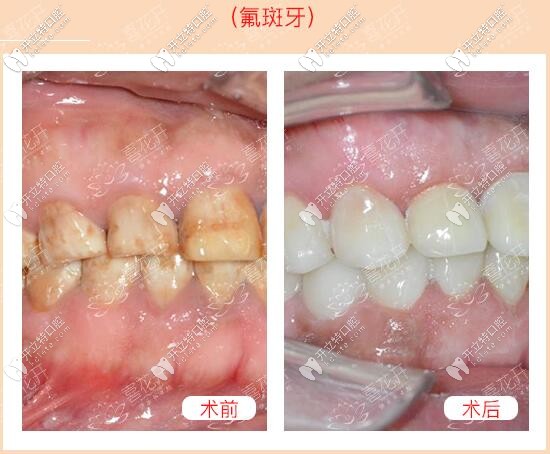 <!--<i data=20240703-sp></i>-->口腔醫(yī)院氟斑牙義獲嘉瓷貼面真人案例 <!--<i data=20240703-sp></i>-->口腔醫(yī)院氟斑牙義獲嘉瓷貼面真人案例