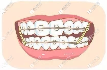 正確的矯正方式 正確的矯正方式