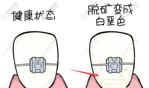 牙齒脫礦還能戴牙套矯正嗎?預防正畸脫礦的治療方法請收好