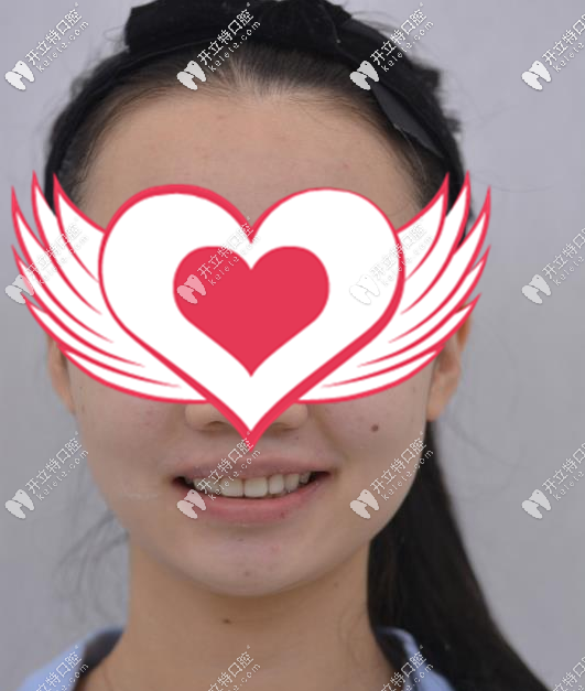 <!--<i data=20240703-sp></i>-->口腔超薄牙齒貼面真人案例