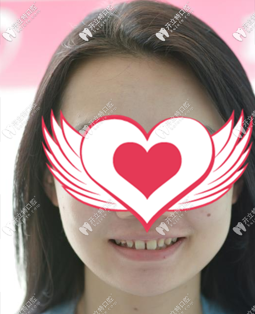 <!--<i data=20240703-sp></i>-->口腔門牙縫隙大牙齒貼面真人案例