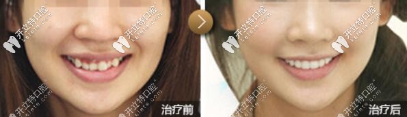 <!--<i data=20240703-sp></i>-->口腔虎牙矯正案例