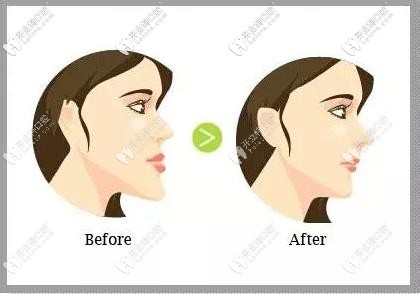 正頜對(duì)面部改善較大