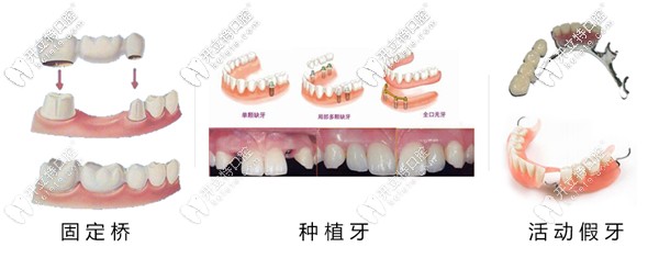 活動假牙和種植牙區(qū)別