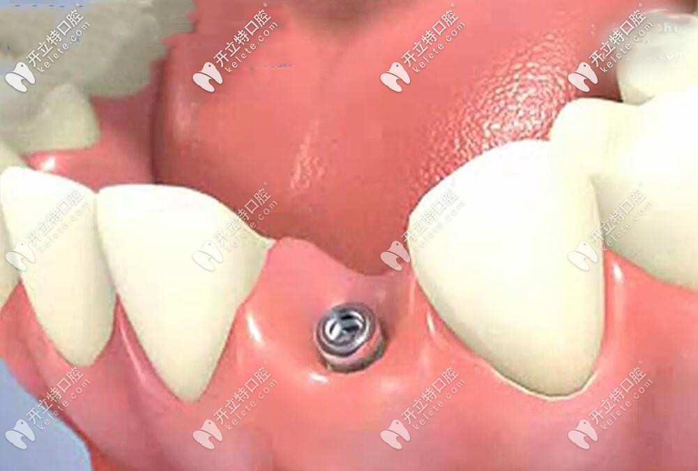 種植牙不會傷害臨牙