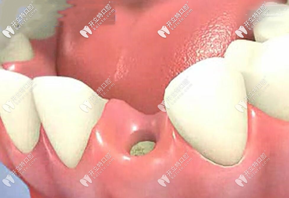 種植牙手術全過程演示