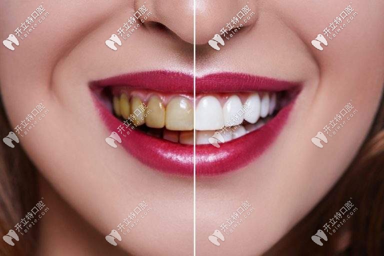 實錘|在沈陽做牙齒貼面5年沒后悔,快看這瓷貼面圖片和過程