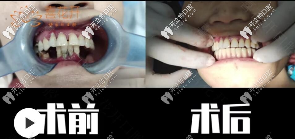 <!--<i data=20240703-sp></i>-->口腔即刻負(fù)重種植牙<span style= <!--<i data=20240703-sp></i>-->口腔即刻負(fù)重種植牙<span style=