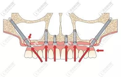 快看穿顴骨種植牙的經(jīng)歷和費用,以防牙齦植入骨粉很后悔