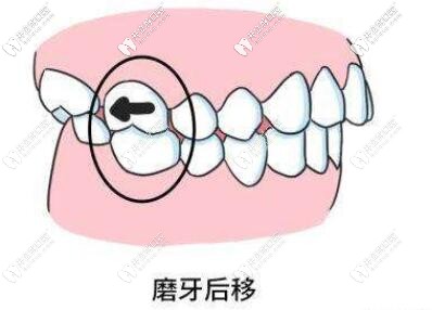 磨牙后推