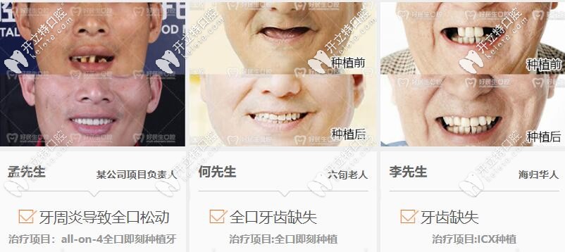 好民生口腔種植案例