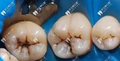 口腔治療中的橡皮障技術(shù) 口腔治療中的橡皮障技術(shù)