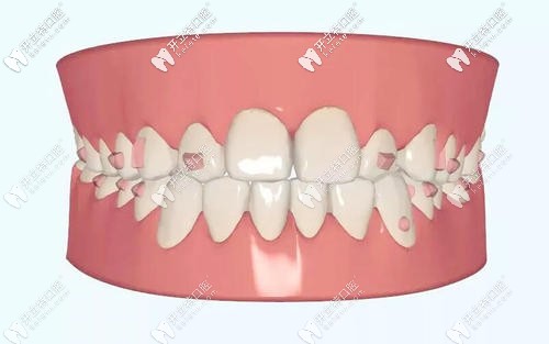 牙齒矯正的設(shè)計方案