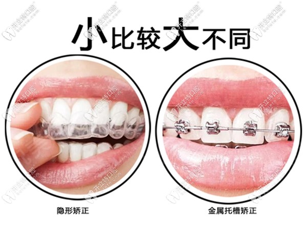 金屬托槽矯正和隱形矯正區(qū)別