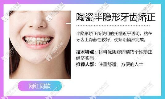 半隱形矯正的優(yōu)勢(shì)